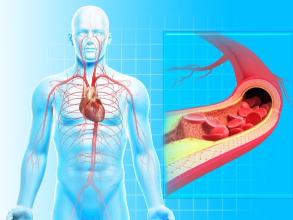 Enfermedad Coronaria