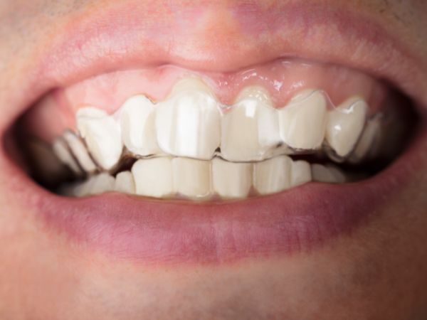 alineadores transparentes