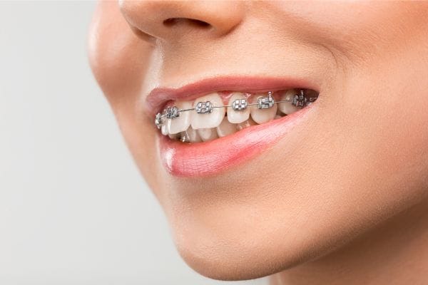 ortodoncia tradicional 