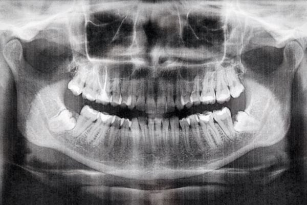 ortodoncia tradicional 